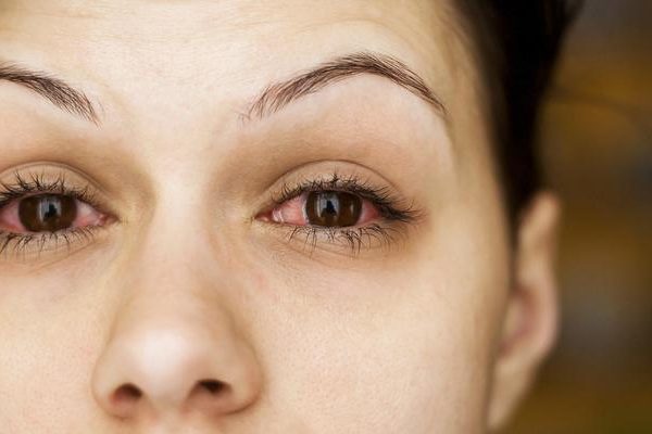 Bulaşıcı “kırmızı göz” hastalığı alarma geçti!  Hızla yayılıyor: Vaka sayısı 7 bin 500'ü aştı